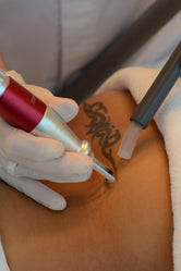 Voorschot 50 euro eerste 3 beurten tattooremoval 20%